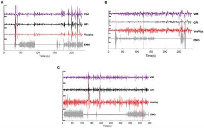 Increased movement-related signals in both basal ganglia and cerebellar output pathways in two children with dystonia